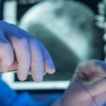 A close-up photo of an interventional radiologist with gloved hands, holding a stent